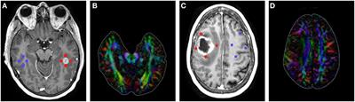 High-grade Gliomas Exhibit Higher Peritumoral Fractional Anisotropy and Lower Mean Diffusivity than Intracranial Metastases